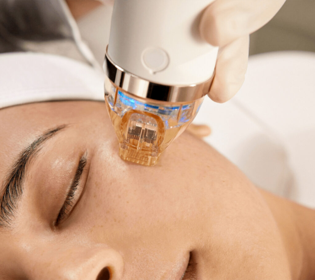 RF Secret Microneedling Tone Cosmetics in Zofingen